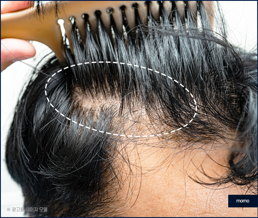 M자모발이식비용 가격 탈모 탈출을 위한 관련 이미지 4