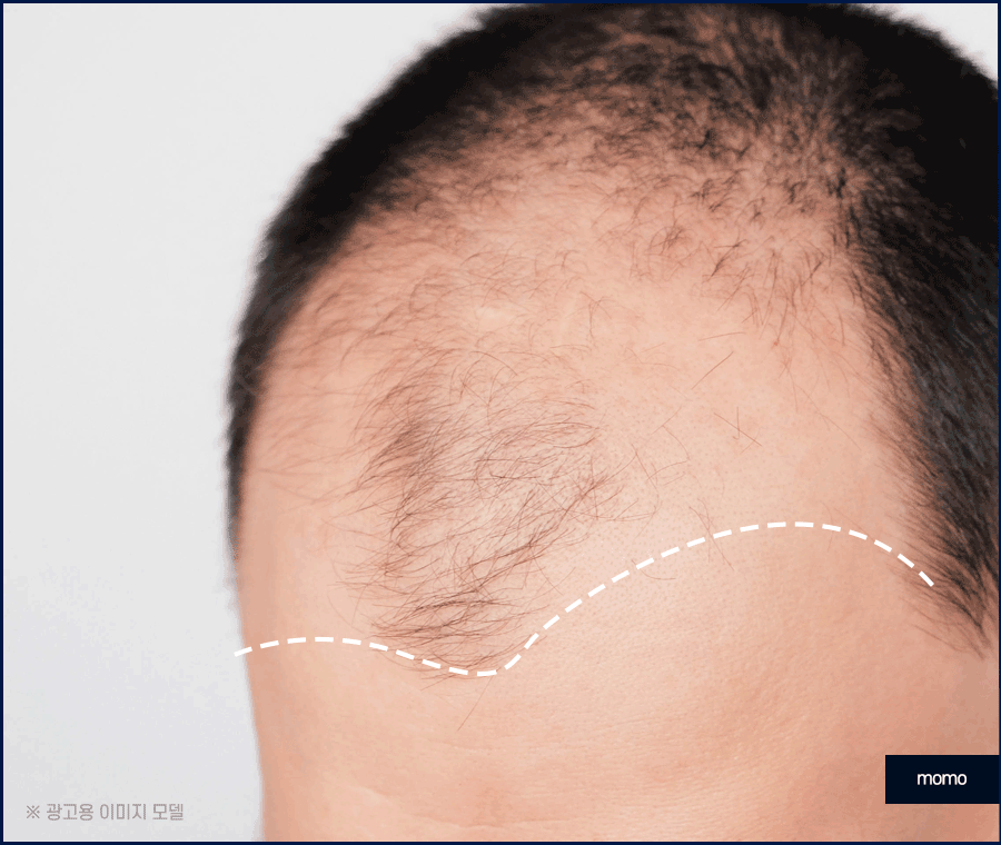 모발이식병원추천 개인에게 맞춰 진단하는 곳으로 관련 이미지 9