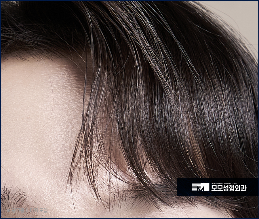 앞머리갈라짐 탈모 해결 방법까지 알아 보는 관련 이미지 4