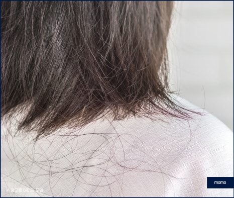 압구정 모발이식 탈모 문제를 해소하는 관련 이미지 3