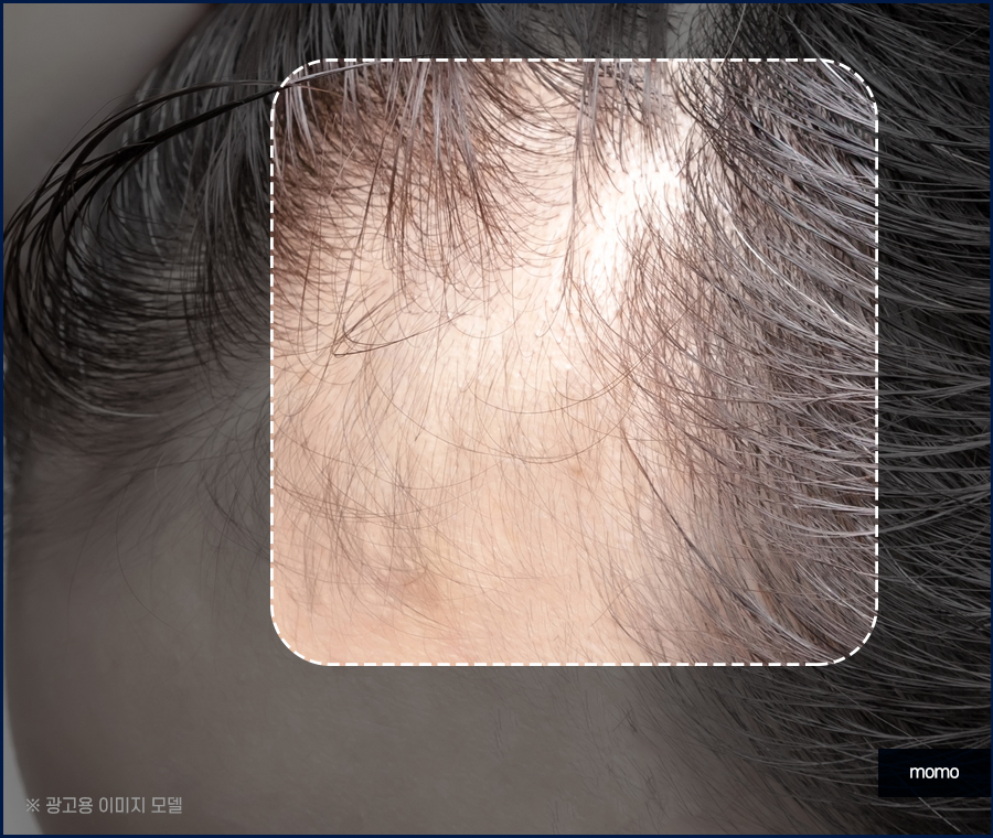 모발이식 절개 비절개 방법을 비교 분석해 가며 관련 이미지 8