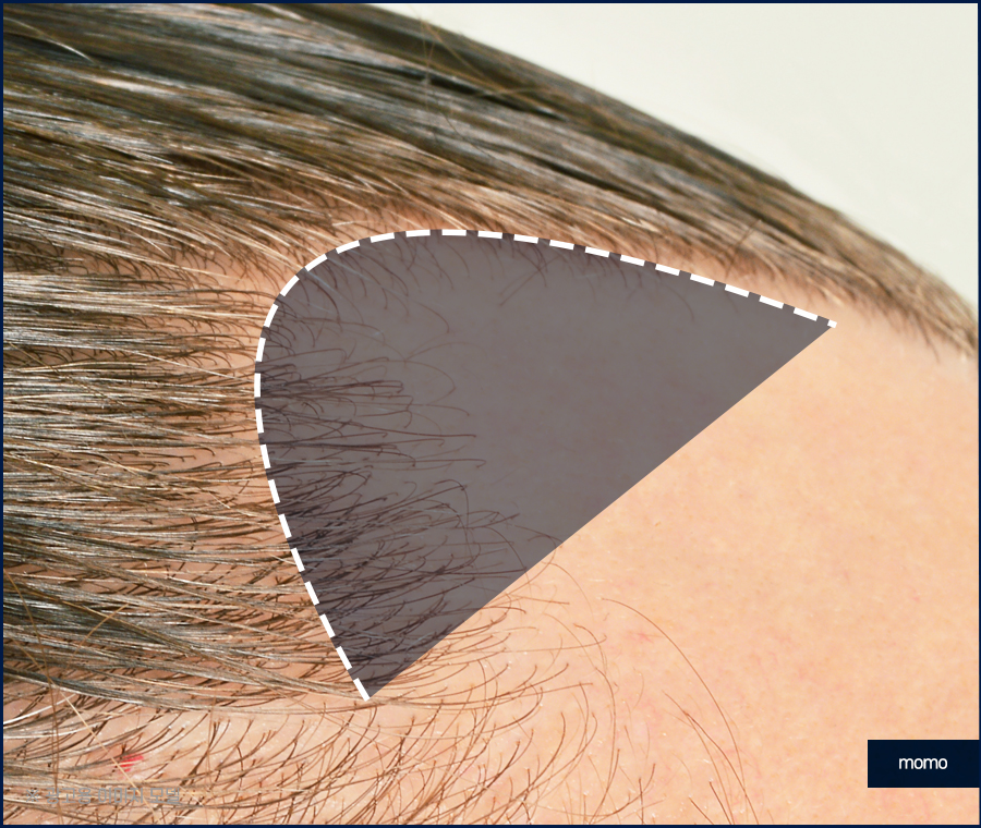 여자m자탈모 헤어라인 디자인까지 고려해 채우는 관련 이미지 8