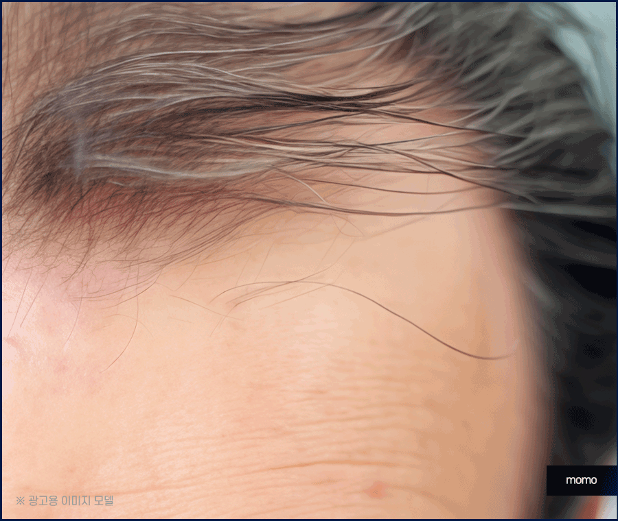 머리심기 비용 및 시술별 장단점 알아보기 관련 이미지 9