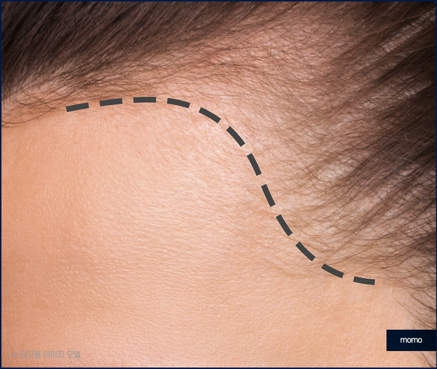 앞머리 모발이식 가격 차이부터 확인하며 관련 이미지 9
