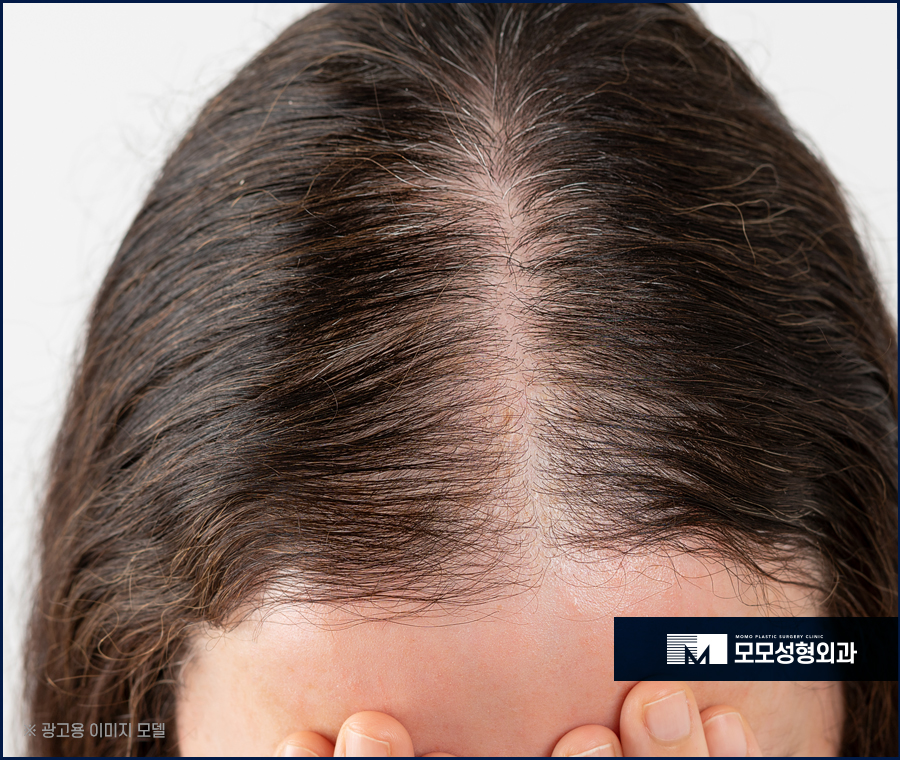 여성모발이식비용 알아 볼 때 고려해야 하는 점 관련 이미지 2