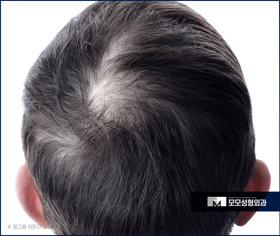 비절개모발이식병원 다방면에서 살펴 보고 관련 이미지 2