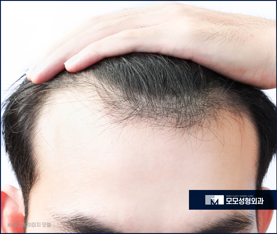 헤어라인교정후기 특성을 고려해서 관련 이미지 3