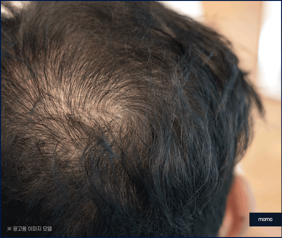모발이식 생착률 높이기 위한 솔루션은 관련 이미지 8