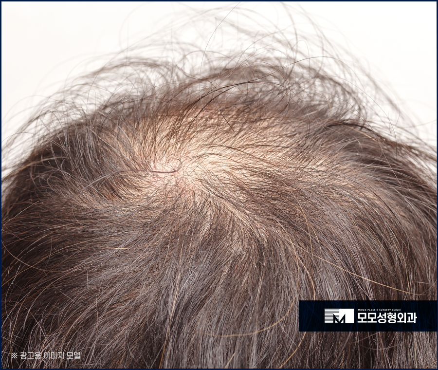 모발이식개구리알 발생 이유와 생착률과의 관계 관련 이미지 4