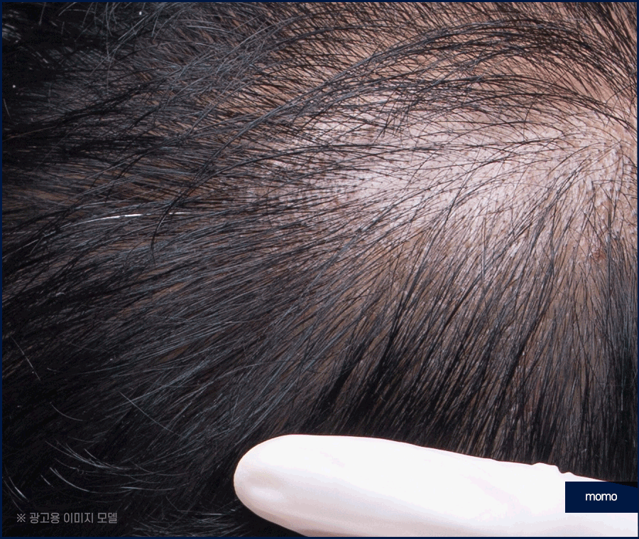 압구정 헤어라인 모발이식 라인 디자인으로 높인 완성도 관련 이미지 8