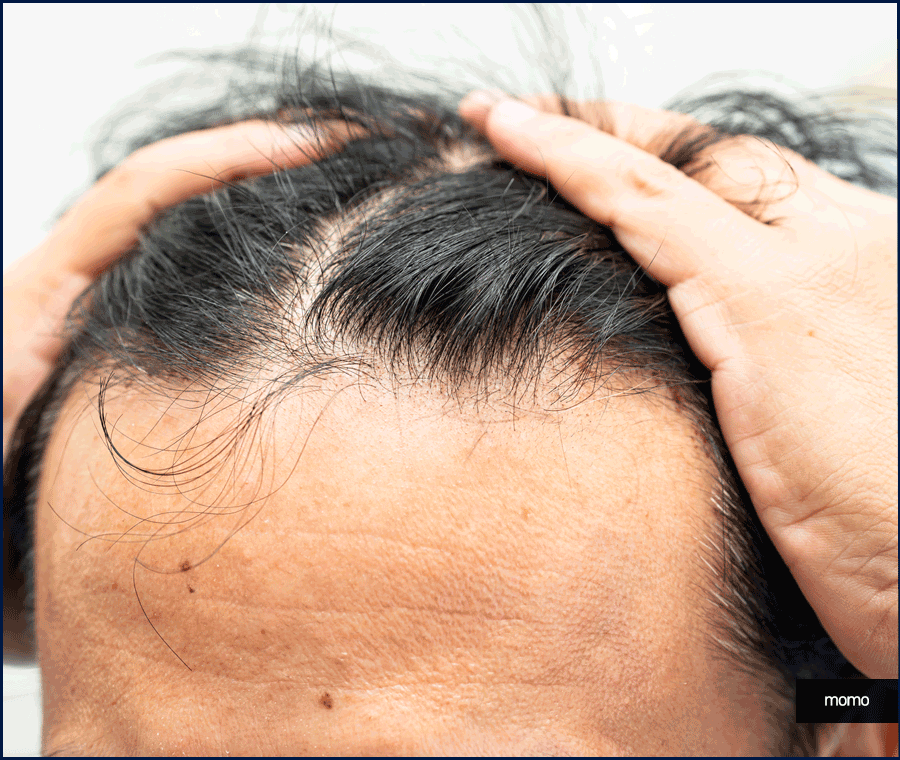 모발이식 생착률 높이기 위한 솔루션은 관련 이미지 12