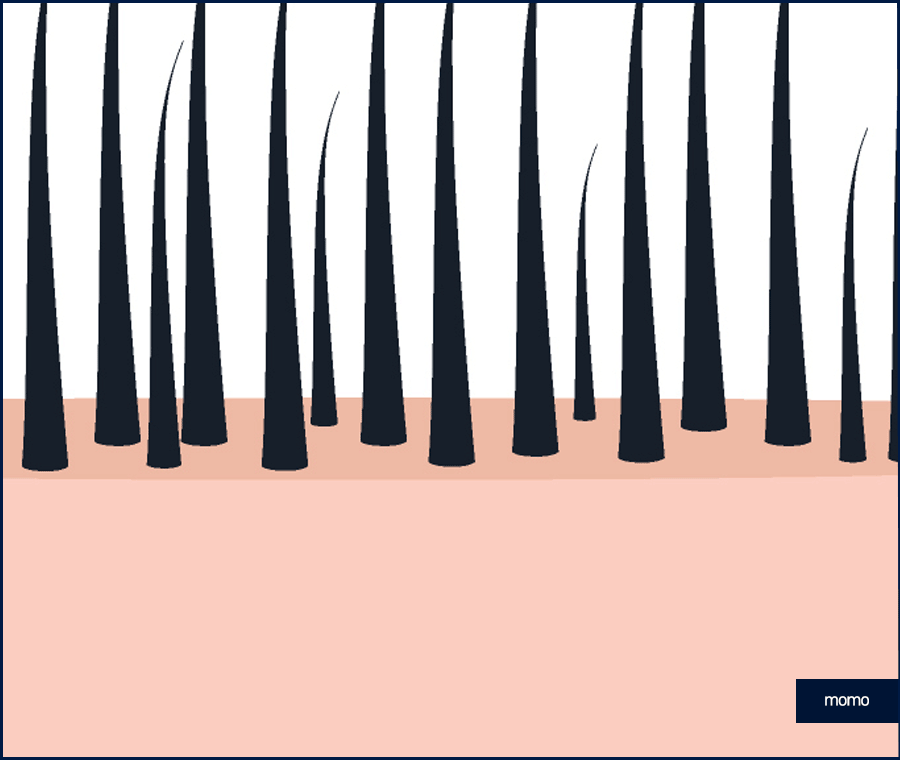 모발이식전후 확인 중이라면 꼭 체크할 핵심 요소 관련 이미지 9