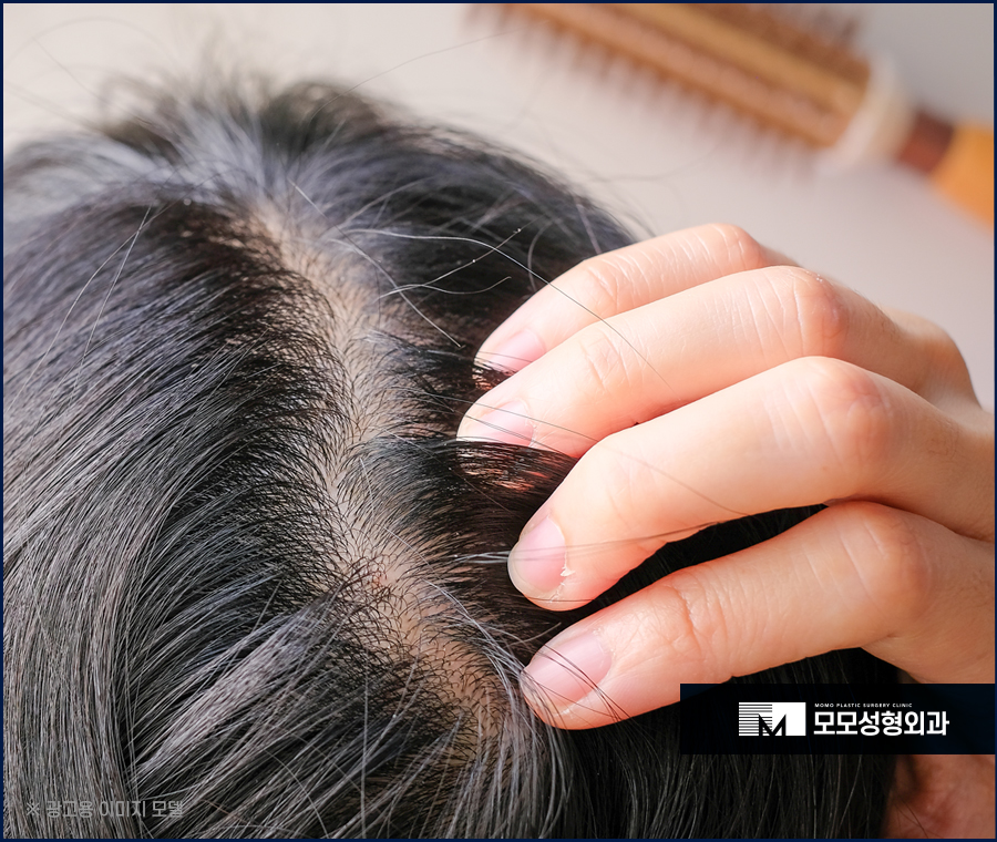가르마모발이식 하얗게 보이던 부분을 채워서 관련 이미지 4