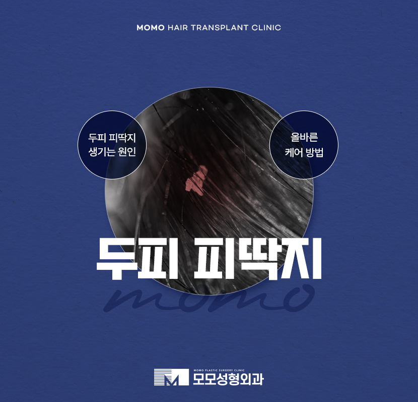 두피피딱지 원인 및 올바른 케어 방법은? 관련 이미지 1