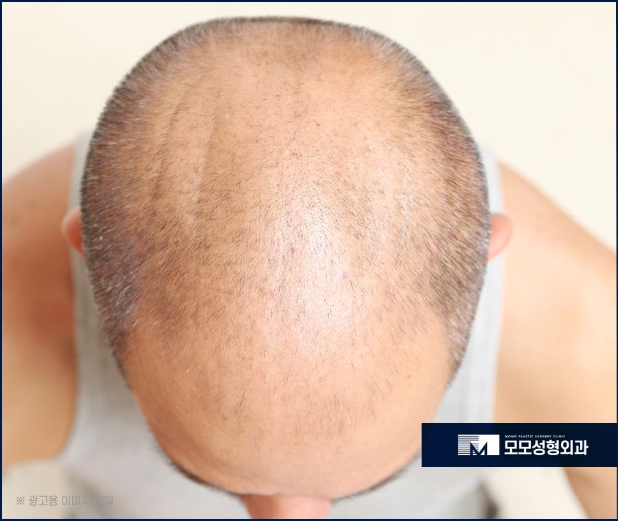 모발이식5000모 상태에 맞는 진단으로 관련 이미지 3