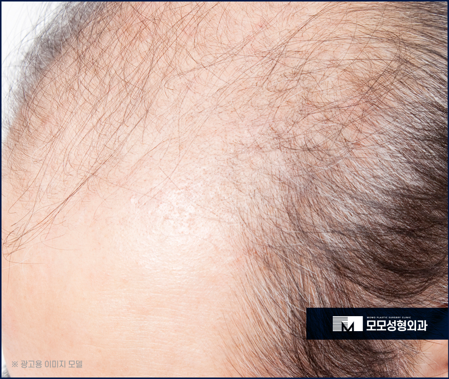 신사동 모발이식 헤어스타일을 자유롭게 연출하기 위한 관련 이미지 5