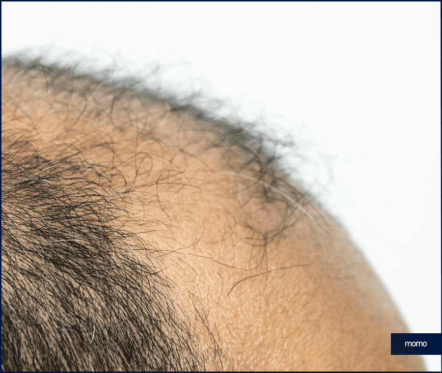 이마 축소술 비용 및 모발이식이 선호되는 이유 관련 이미지 6