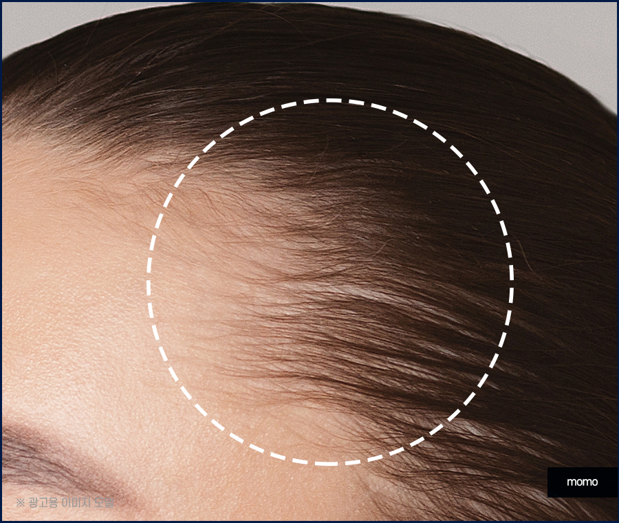 여자 헤어라인 모발이식 외모 자신감을 높이는 관련 이미지 4