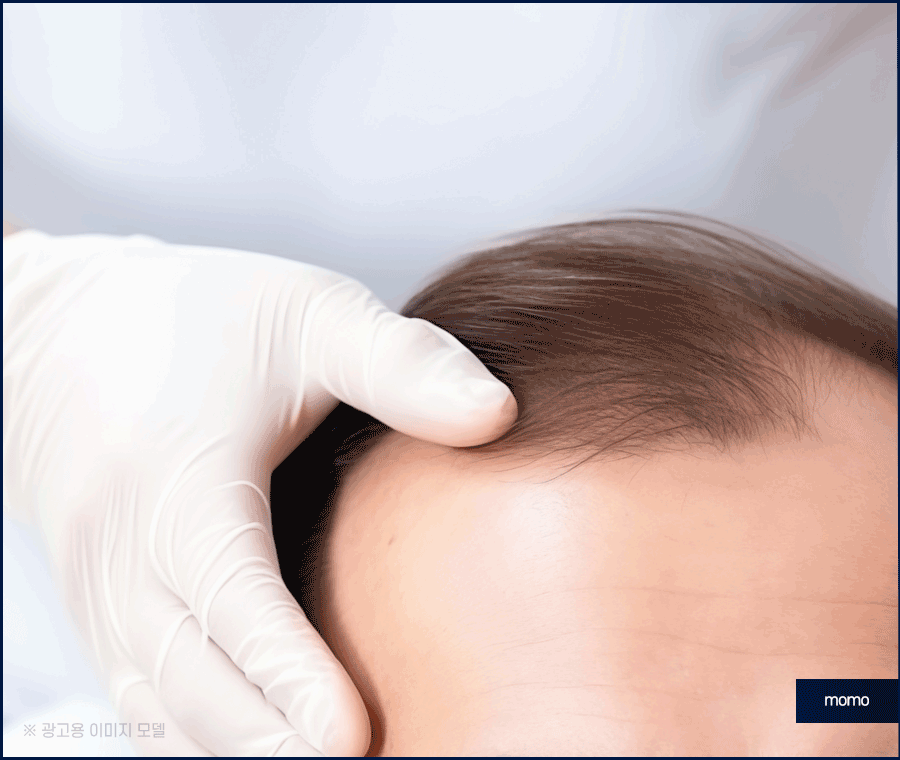 압구정 헤어라인 모발이식 라인 디자인으로 높인 완성도 관련 이미지 5
