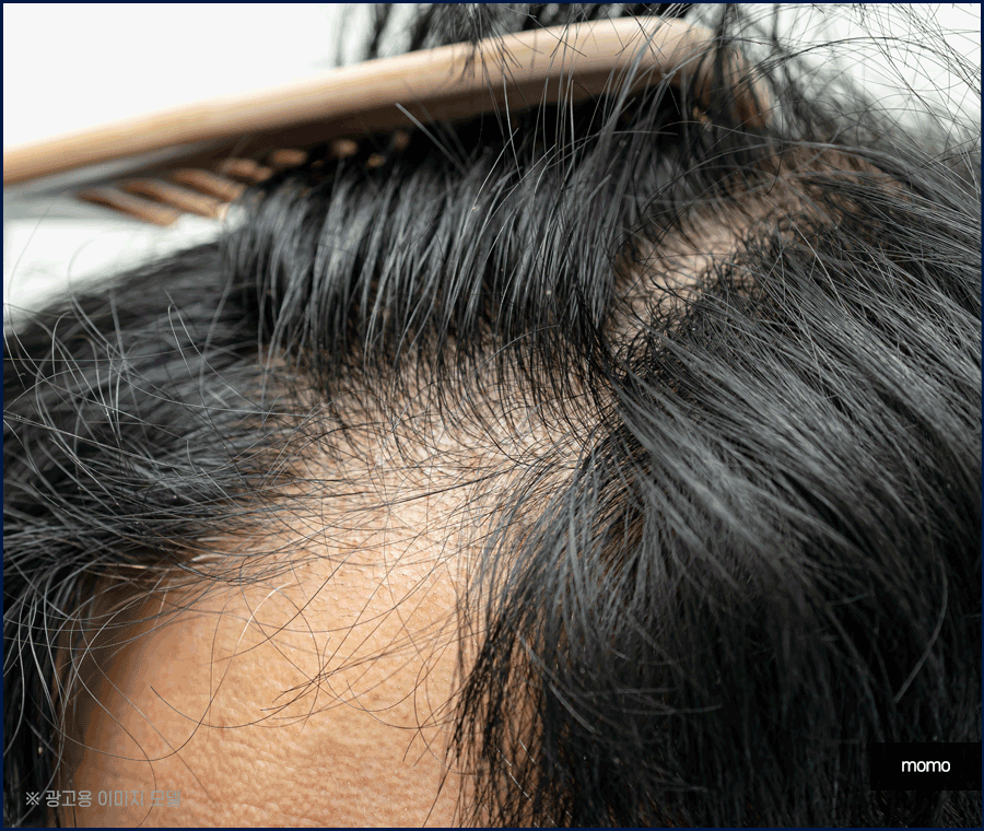 앞머리 모발이식 비용 개인에 따라 달라지는 이유 관련 이미지 6