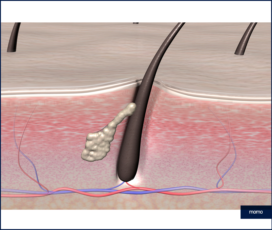 두피 종기 원인 및 치료, 관리 방법 관련 이미지 6