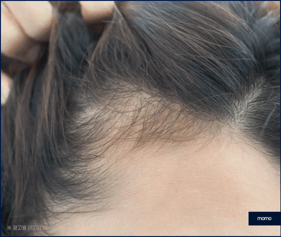 앞머리 모발이식 비용 개인에 따라 달라지는 이유 관련 이미지 13