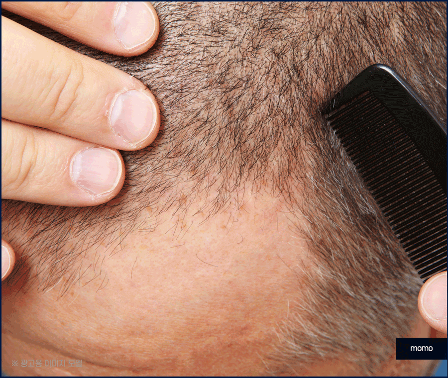 엠자이마 탈모 헤어라인 모발이식으로 관리하기 관련 이미지 9