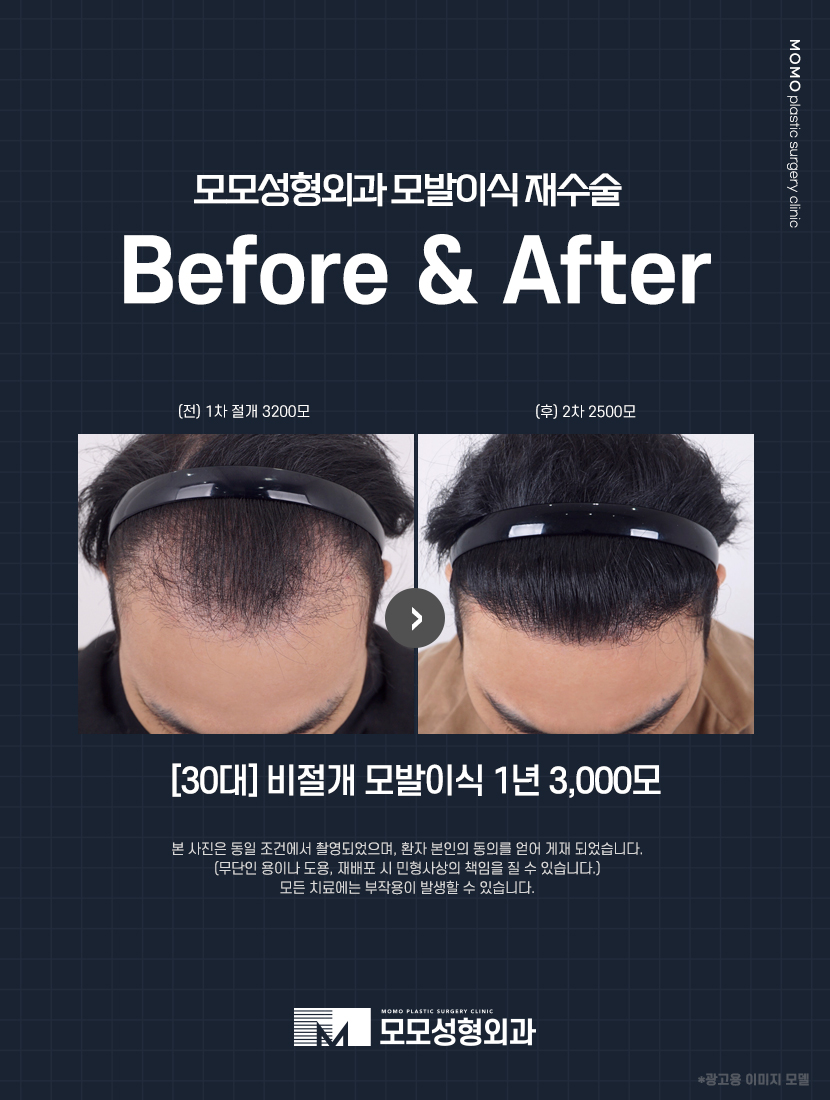 머리심는비용 비절개가 선호되는 이유에 대해 관련 이미지 8