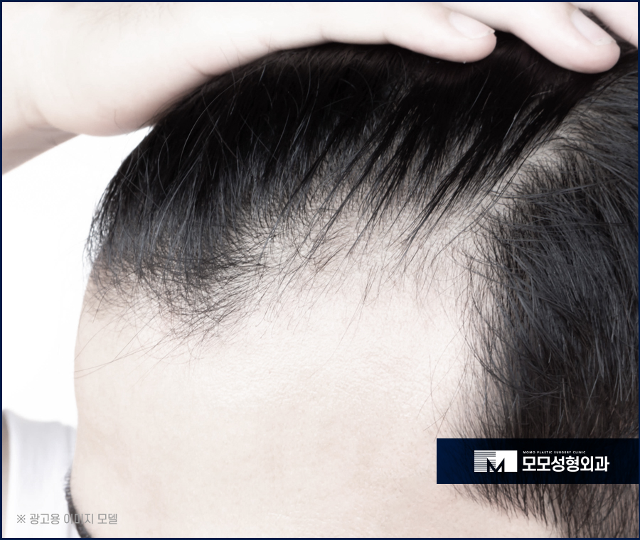 남자앞머리탈모원인과 극복하기 위한 방안에 대해 관련 이미지 2