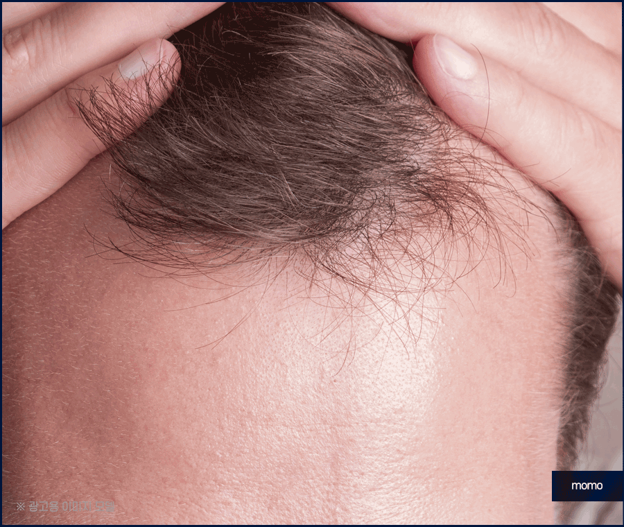 m자탈모병원 모발이식 고민이신 분들이라면 필독 관련 이미지 3
