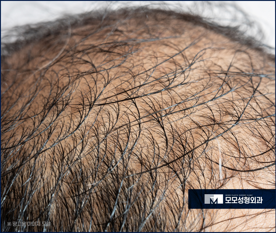 m자탈모모발이식비용 어느 정도가 적절할까요 관련 이미지 8