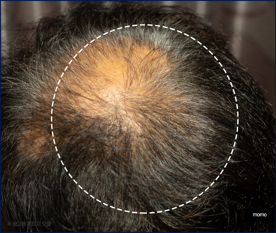 머리심기비용이 달라지는 이유와 차이점 관련 이미지 6