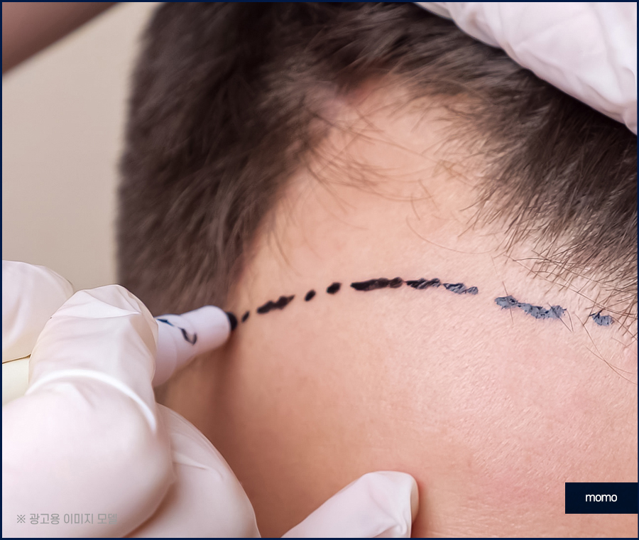 헤어라인모발이식비용 생착률을 높여가면서 관련 이미지 8