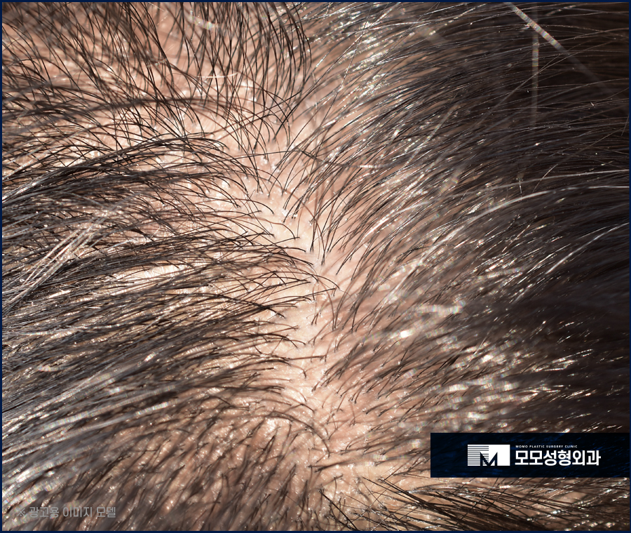 겨울철 두피관리 건강한 상태를 유지하기 위해 지켜주세요 관련 이미지 2