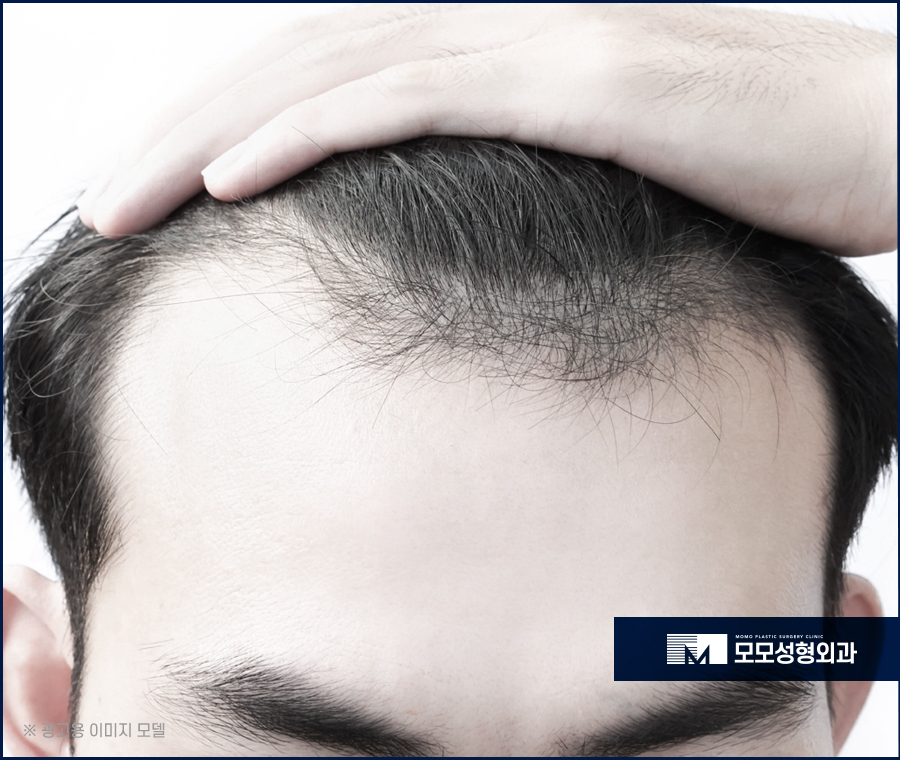 남자앞머리탈모원인과 극복하기 위한 방안에 대해 관련 이미지 4