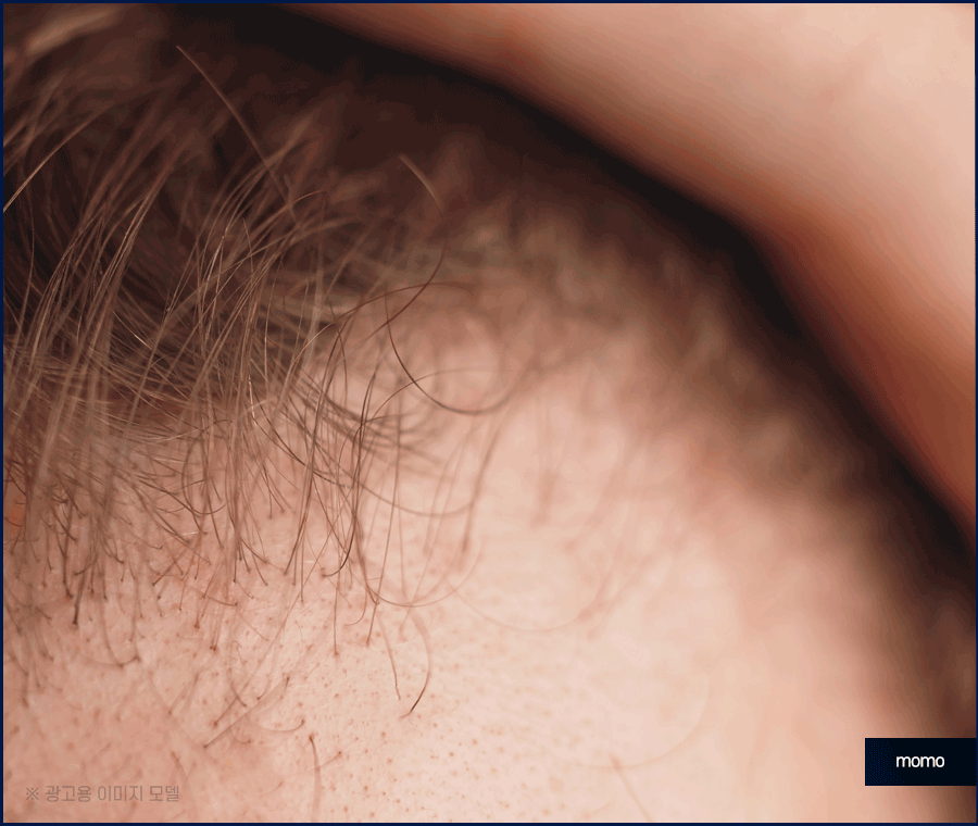 엠자 탈모 섬세하게 채워 만드는 변화 관련 이미지 9