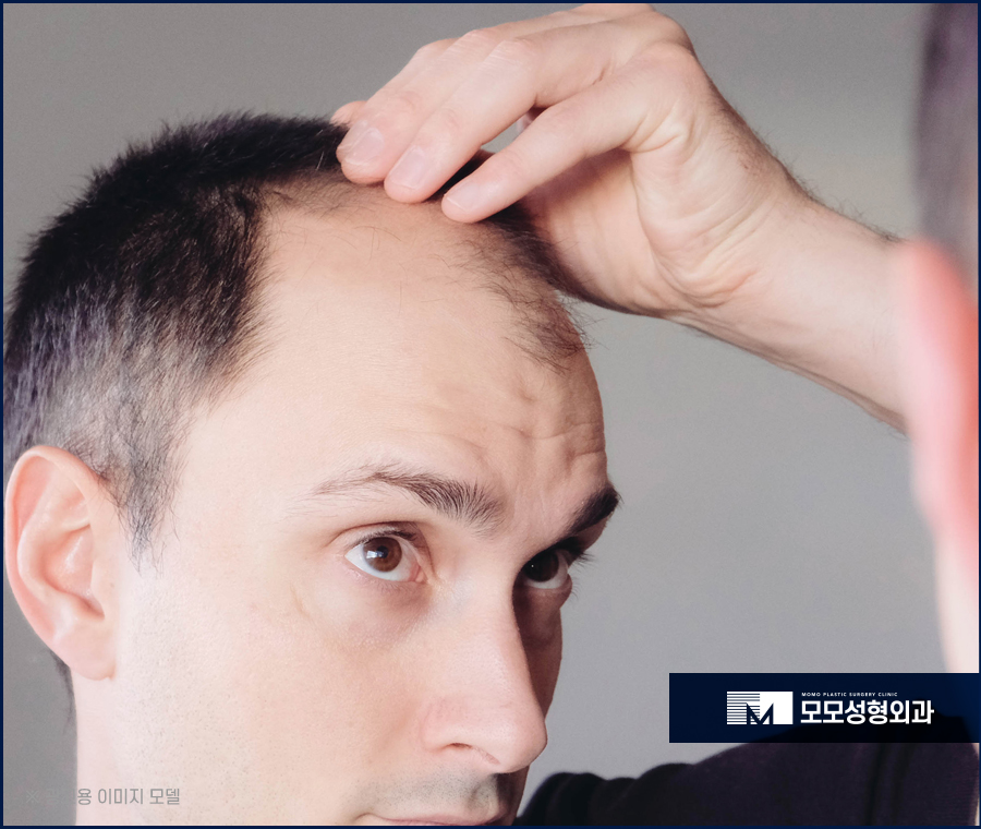 남자헤어라인교정 정교하게 채우고 생착률을 높이는 관련 이미지 5
