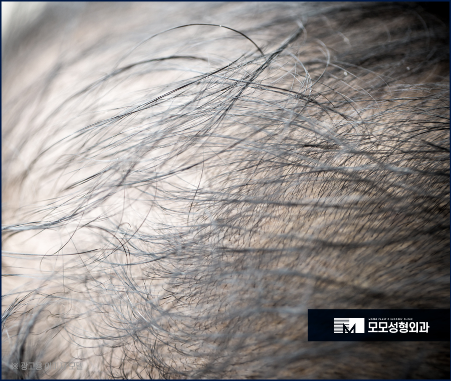 무삭발모발이식 비절개로 걱정을 줄이며 관련 이미지 3