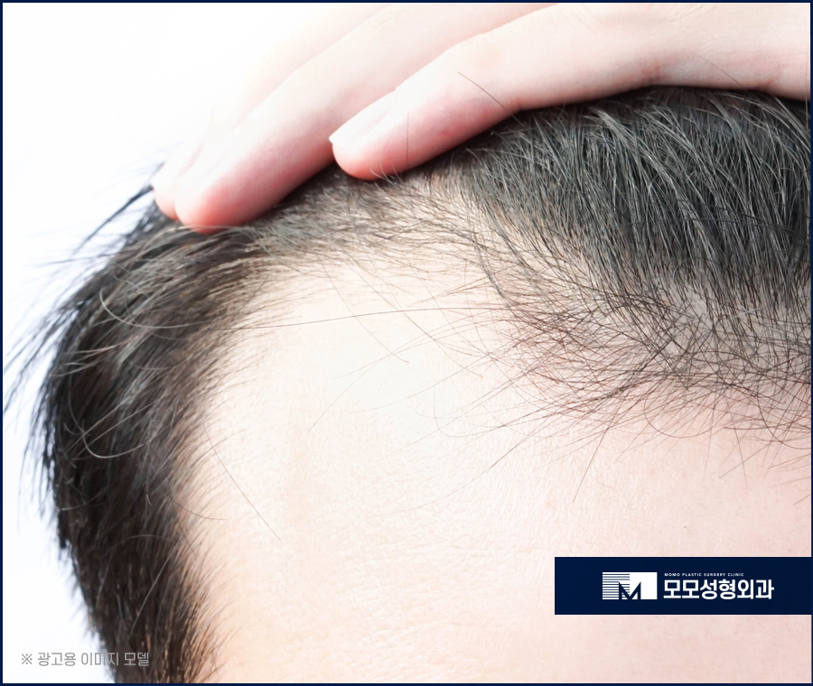 m자탈모초기증상 면밀하게 관찰해야 하는 이유 관련 이미지 4