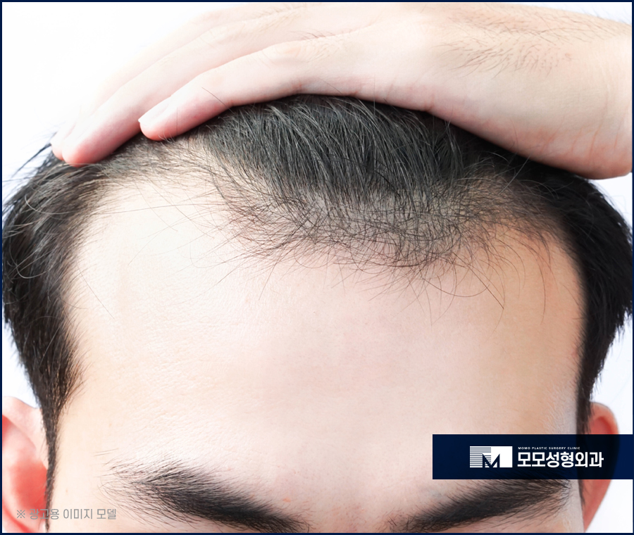 안드로젠탈모증 증상과 호전을 위한 방법은 관련 이미지 4