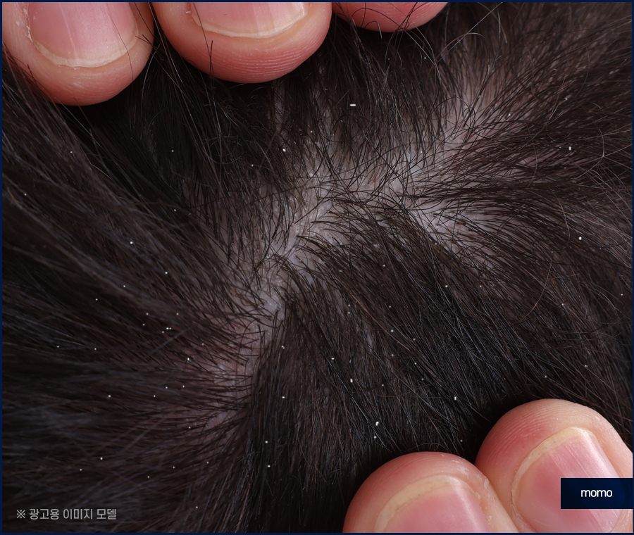머리비듬없애는법 효과적인 비결에 대해 관련 이미지 7