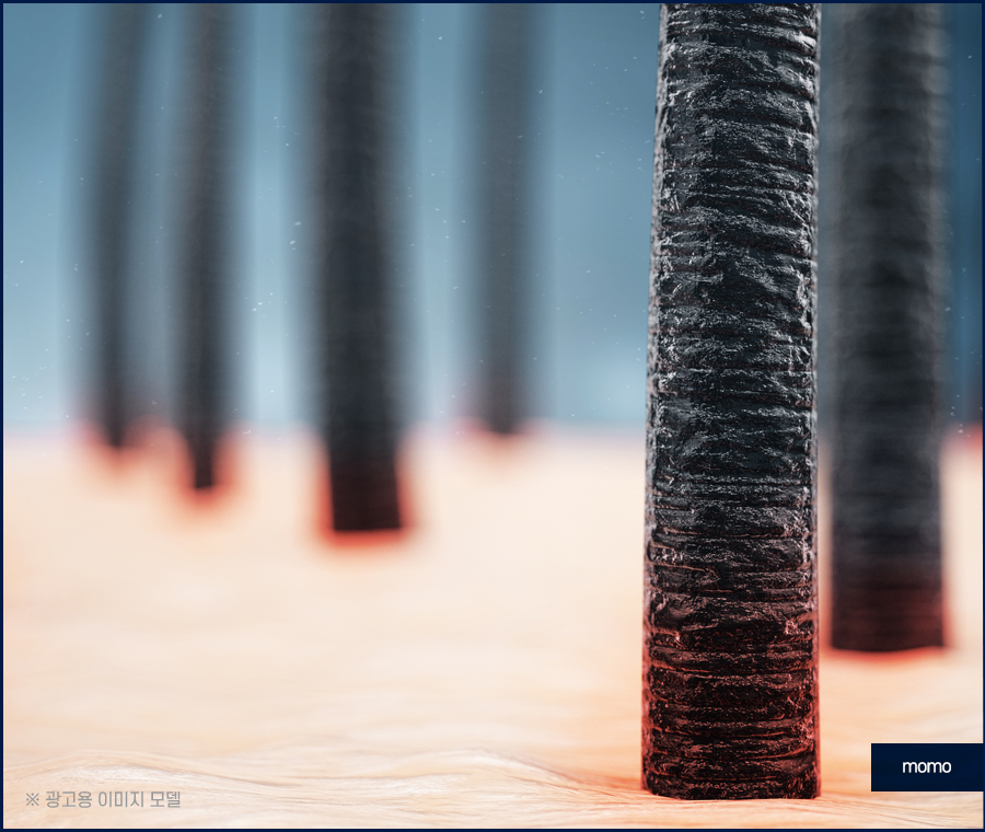 모발이식 생착률 기준짓는 요소들은 무엇일까 관련 이미지 4