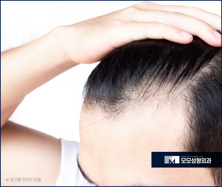 신사모발이식 탈모에 대응하는 방법 관련 이미지 3