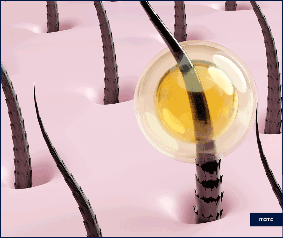 모발이식 생착률 높이기 위한 솔루션은 관련 이미지 4