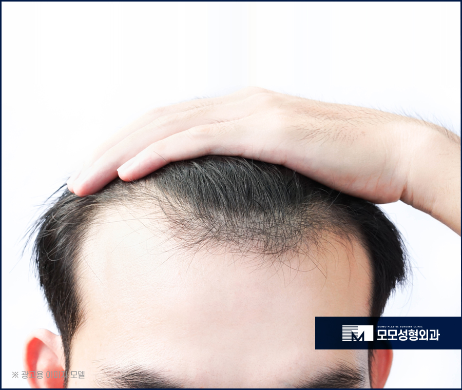 비절개모발이식비용 가격이 아깝지 않은 결과로 관련 이미지 3