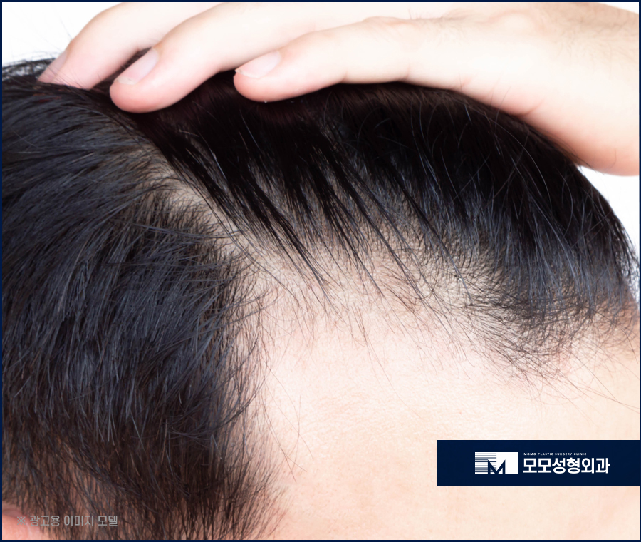 남자헤어라인교정 정교하게 채우고 생착률을 높이는 관련 이미지 3