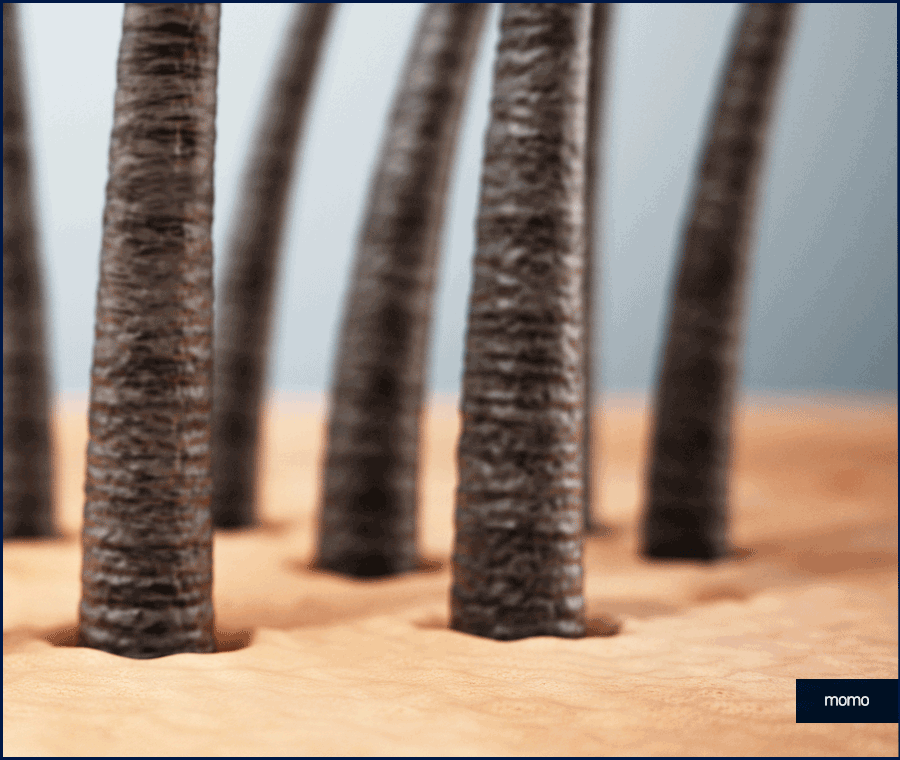 압구정 헤어라인 모발이식 라인 디자인으로 높인 완성도 관련 이미지 2