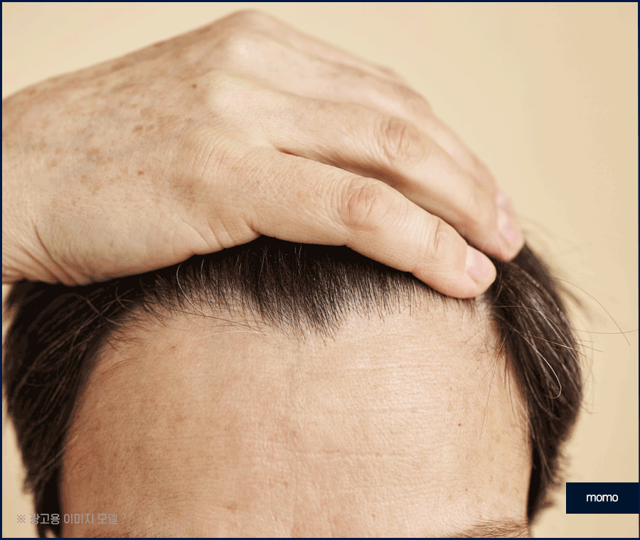 엠자이마 탈모 헤어라인 모발이식으로 관리하기 관련 이미지 3
