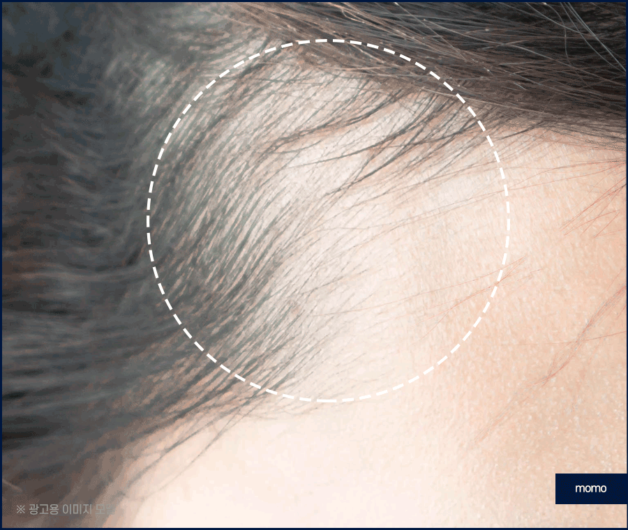 엠자이마 탈모 헤어라인 모발이식으로 관리하기 관련 이미지 2