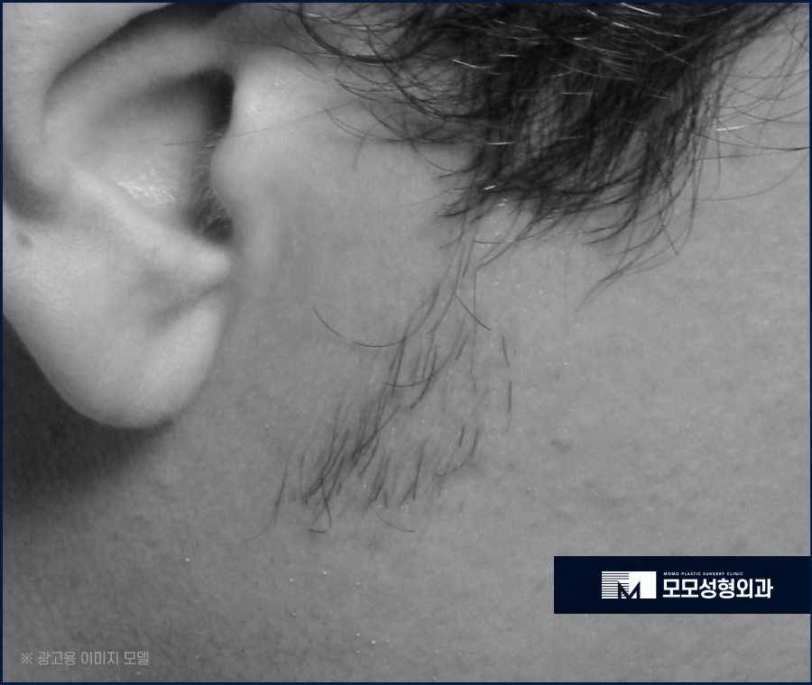 구렛나루 탈모 퍼스널 디자인으로 자연스럽게 관련 이미지 6